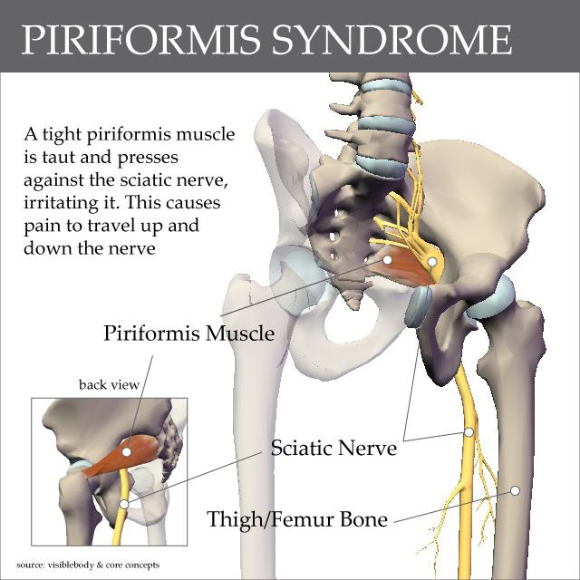 Sciatica vs. Piriformis Syndrome.jpg